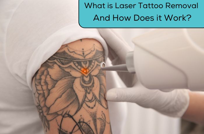 What is Laser Tattoo Removal And How Does it Work?