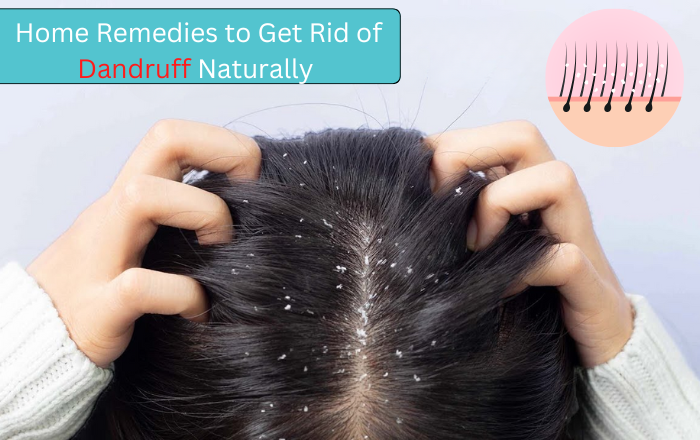 Home Remedies to Get Rid of Dandruff Naturally