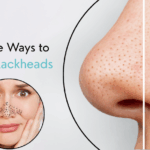 How to Get Rid of Blackheads: Effective Treatments and Tips