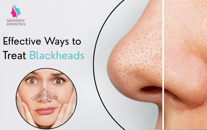 How to Get Rid of Blackheads: Effective Treatments and Tips