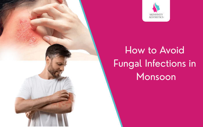 How to Avoid Fungal Infections in Monsoon