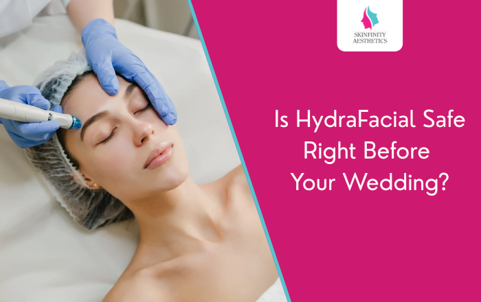 HydraFacial for Brides: Is It Safe Right Before the Wedding?