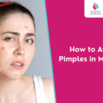 How to Prevent Pimples in the Rainy Season?