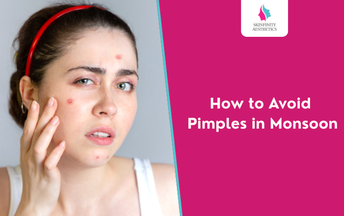 How to Prevent Pimples in the Rainy Season?