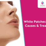 White Patches on Skin: Causes, Symptoms & Treatment Options