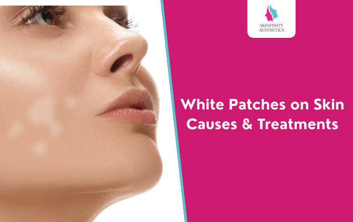 White Patches on Skin: Causes & Treatments
