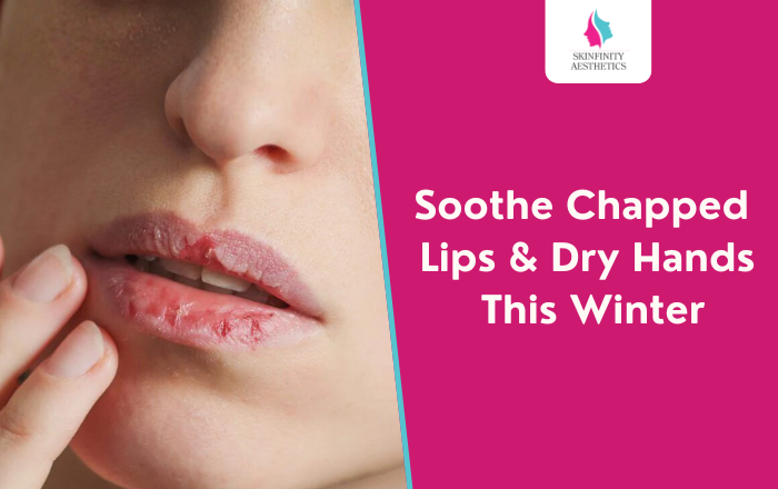 How to Soothe Chapped Lips & Dry Hands This Winter