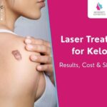 Laser Treatment for Keloids: Results, Cost & Side Effects