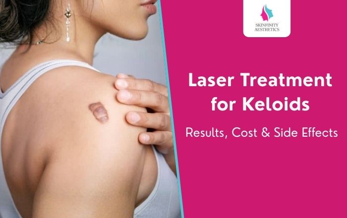 Laser Treatment for Keloids Results, Cost & Side Effects