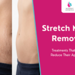Stretch Marks Removal: Treatments That Actually Reduce Their Appearance
