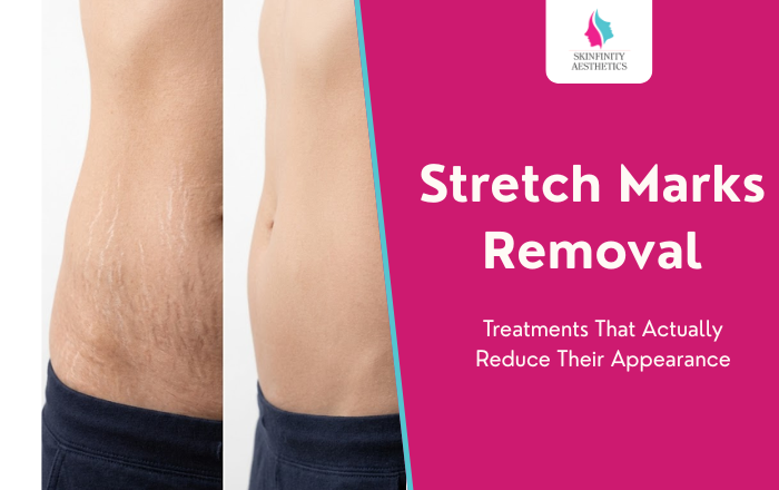 Stretch Marks Removal Treatments That Actually Reduce Their Appearance